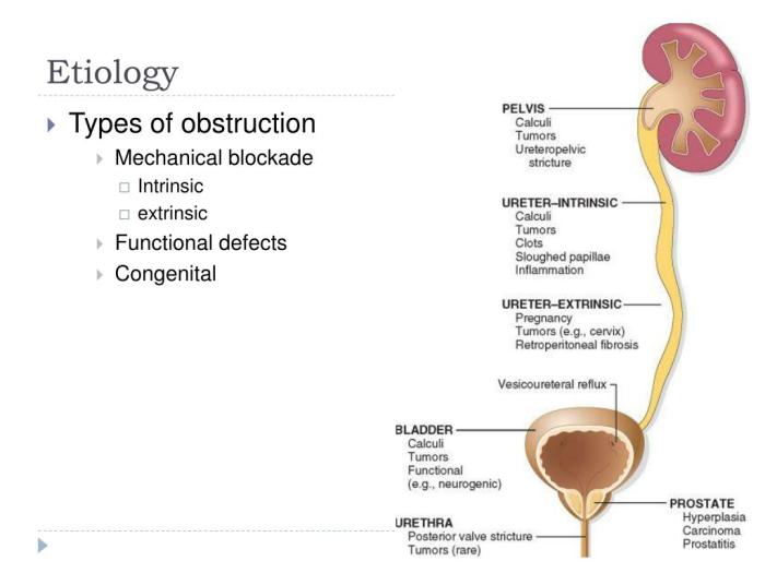 Obstruction urinary tract etiology mechanical intrinsic extrinsic functional congenital defects blockade types ppt